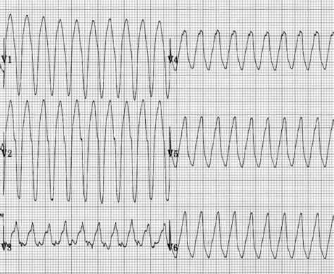 VT versus SVT • LITFL Medical Blog • ECG Library Basics