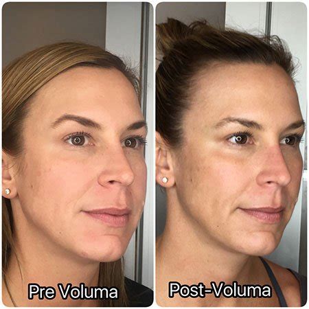 Juvéderm Fillers – Adore Aesthetix