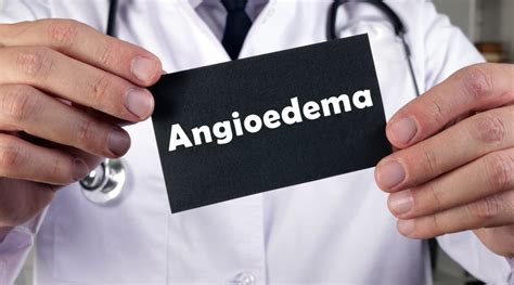 Angioedema: What are its Causes and Symptoms? - HK Vitals