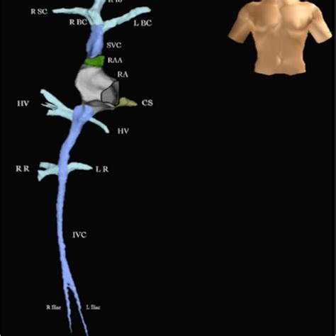 ICE image of PVC ablation. The PVC origin is from the anterolateral ...