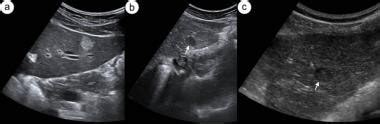 Hepatic Hemangiomas Workup: Laboratory Studies, Imaging Studies, Procedures