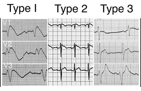 Brugada syndrome and sports activity: from history to risk stratification