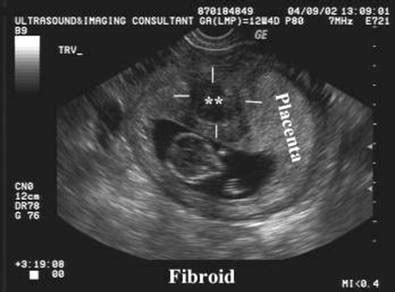 OB 1 st TRIMESTER ABNORMAL FINDINGS - Sonography folder