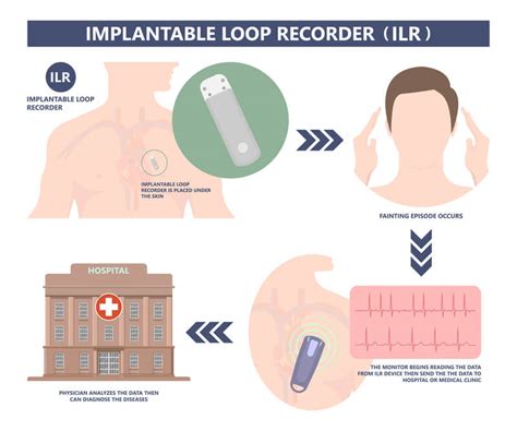 Loop Recorder Implantation | Sydnor Cardiovascular Center