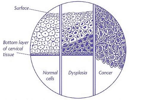 Understanding Abnormal Pap Test Results - WomenCare of Baldwin Park