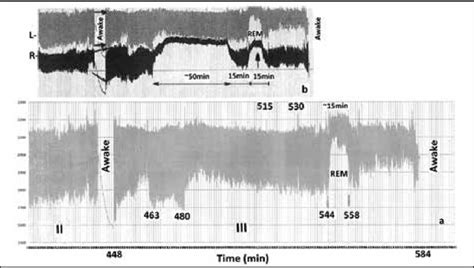 a). Slow transitions in the nasal cycle of both nostrils. b). Impulse... | Download Scientific ...