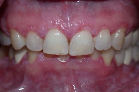 Desquamative gingivitis, definition, causes, symptoms, diagnosis & treatment