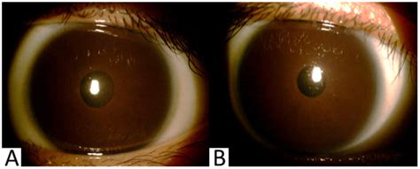 The right eye (A) and the left eye (B). There are iridodonesis and... | Download Scientific Diagram