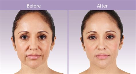 Dermal Fillers - Transform Me Med Spa