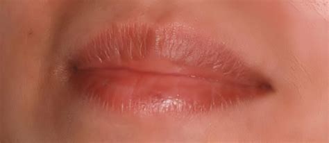 Venous Lakes Lip Laser Treatment in Phoenix, AZ - Atrium Dental