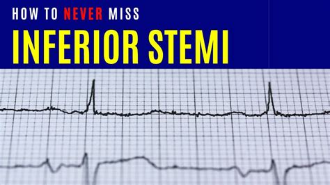 How to never miss Inferior STEMI - YouTube