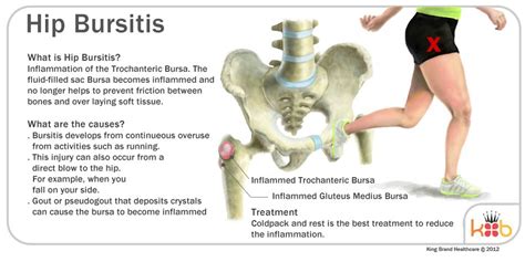 Chronic Hip Bursitis Pain