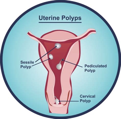 Dra. Joana Faria - Uterine polyp - Lisbon, Portugal