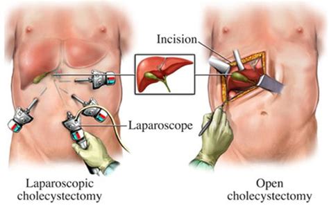 Laparoscopic Cholecystectomy - Laser Stone Surgery & Endoscopy Centre