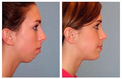 Plastic Surgery Before And After: Chin Augmentation Before And After