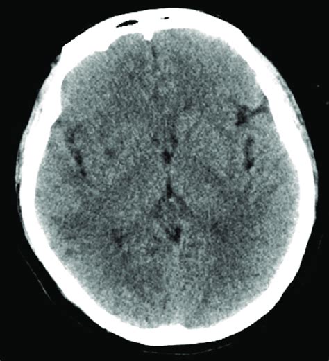 Follow-up CT scan taken 2 d later showing a hypodense lesion in the... | Download Scientific Diagram