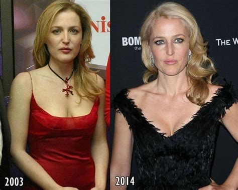 The Right Kind of Changes from Gillian Anderson’s Plastic Surgery | Go ...