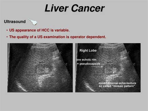 PPT - Liver Cancer PowerPoint Presentation - ID:6399378