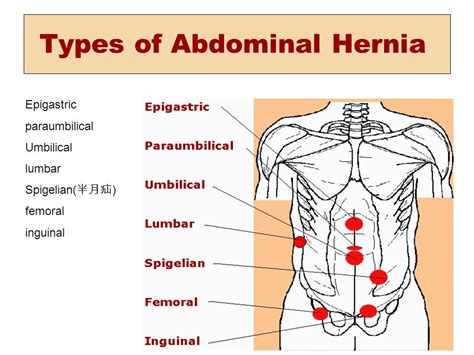 Spigelian Hernias: Causes, Symptoms & Treatments | Global Treatment Services Pvt. Ltd.