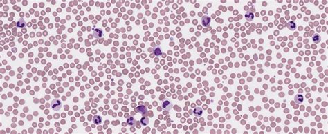 Chronic Neutrophilic Leukemia