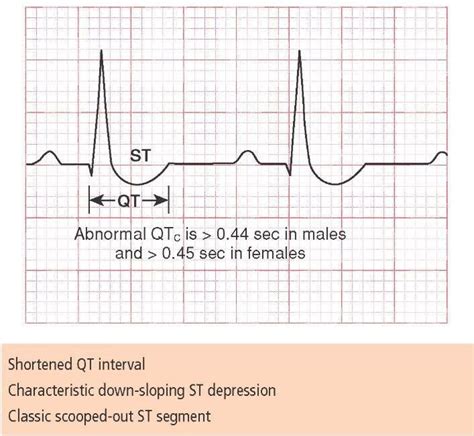 U Wave Depression