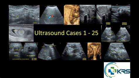 Ultrasound Cases 1-25 - YouTube