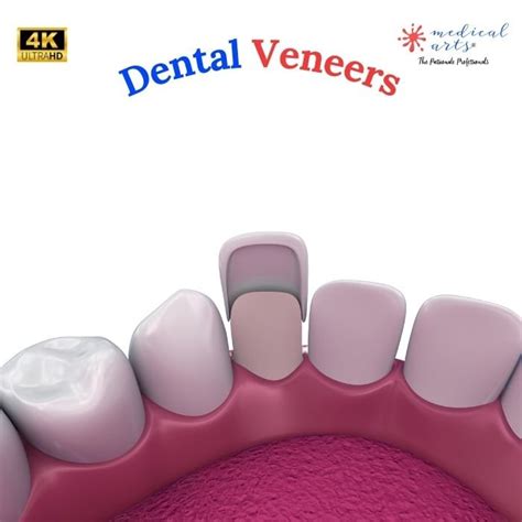 Dental Veneers Procedure - Video & Article – Medical Arts Shop