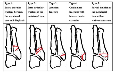 How Are Fifth Metatarsal Fractures Managed By The Virtual Fracture Clinic | CLOOBX HOT GIRL