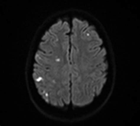 MRI scan (DWI sequence) illustrating the distal embolization related ...