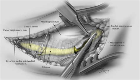 Ulnar Nerve Decompression at the Elbow - Kaitlin Lindsay