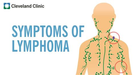 How Quickly Does Lymphoma Develop