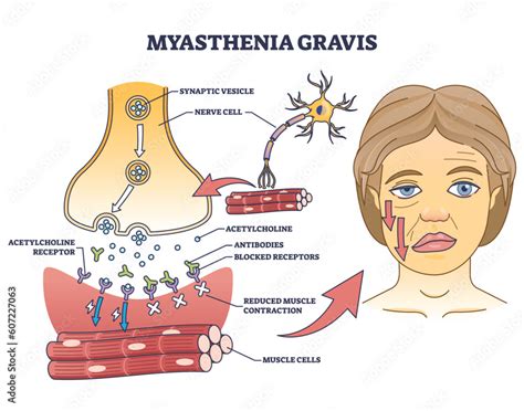 Myasthenia gravis as autoimmune, neuromuscular disease outline diagram. Labeled educational ...