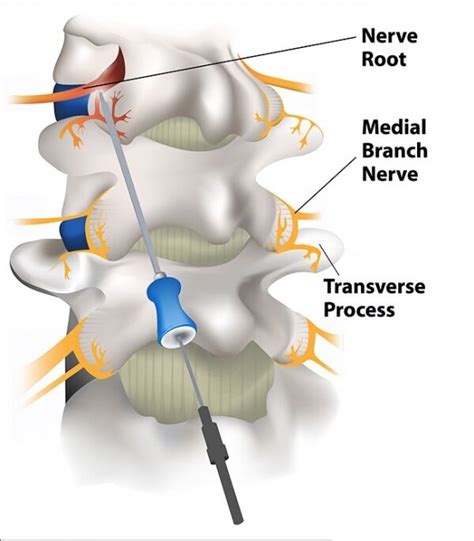 Medial Branch Block — EPIC PAIN MGMT (973)866-0336