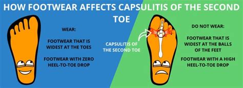 5 Effective Capsulitis Of The Second Toe Treatments You Need To Know!