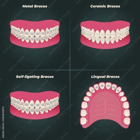 The concept of teeth alignment with braces. Orthodontic dentistry. The ...