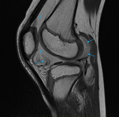 11-juvenile-chronic-arthritis-mri-knee - MRI at Melbourne Radiology Clinic