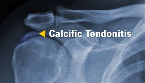 Calcific Tendonitis: Symptoms, Causes, & Treatment