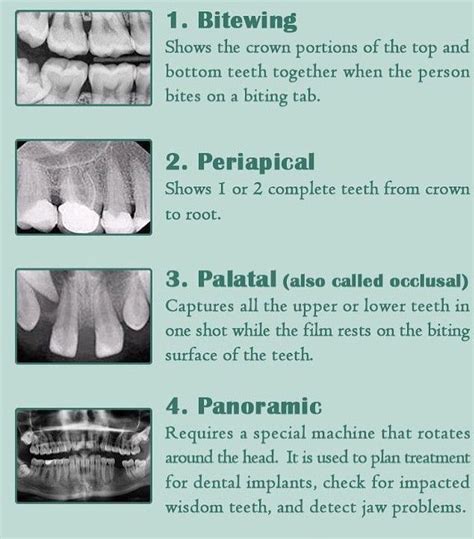 Types of dental X-rays - MEDizzy