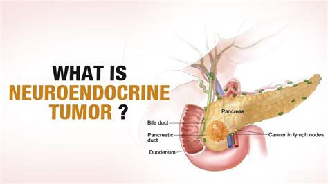 Neuroendocrine - Pancreatica.org