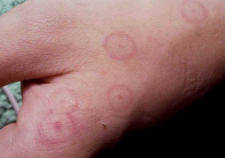 Erythema multiforme - Types, Symptoms, Causes, Diagnosis and Treatment