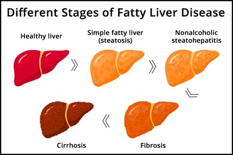 Fatty Liver Disease: Stages, Diagnosis, & Treatment - eMediHealth