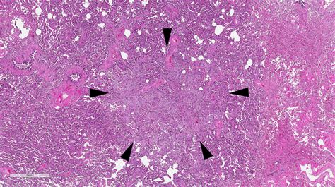 Update on histologic classification of non-small cell lung cancer - Diagnostic Histopathology