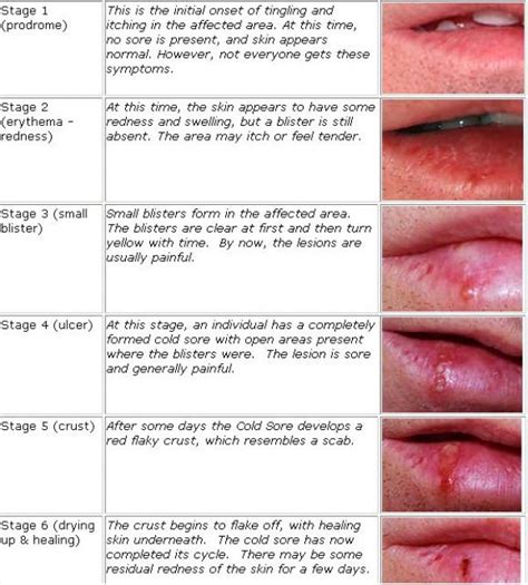 How To Reduce The Visible Signs Of Cold Sore | Cold sore stages, Cold sores remedies, Cold sore ...