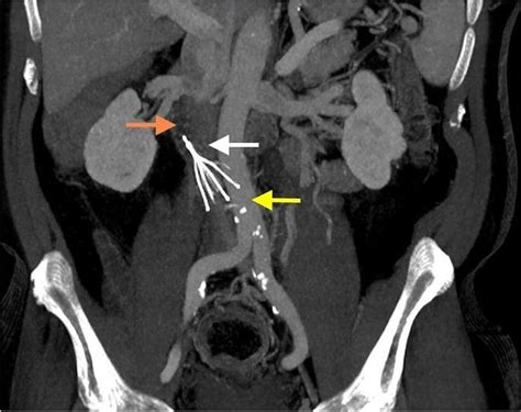 Maximal intensity projection image from an abdominal CT scan showing a malpositioned IVC filter ...