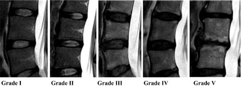 Degenerative Disc Disease: Steroids Vs Stem Cell Therapy - Cornell Pain ...