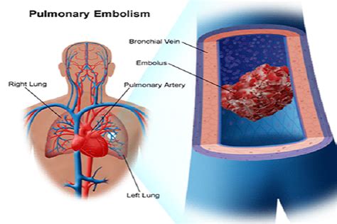 10 Signs of Blood Clot in Lung | Thrombocytes