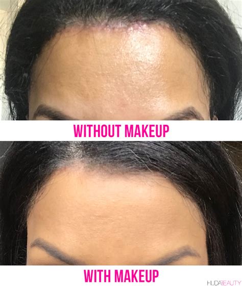 Forehead Reduction Surgery Is A Thing - We Did It! | Blog | HUDA BEAUTY