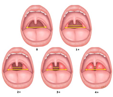 Tonsil Grading - Standardized Grading of Tonsil Size - Pristyn Care