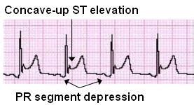 Pericarditis ECG Review | Learn the Heart