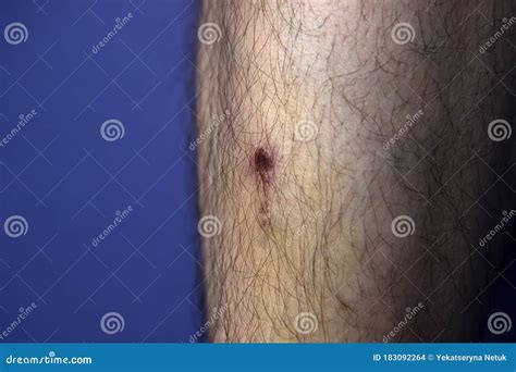 Bruise On The Leg Of A Young Woman. A Bruised Leg. Close-up Royalty ...